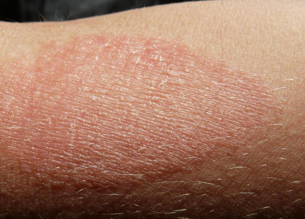 What’s to know about&nbsp;eczema?