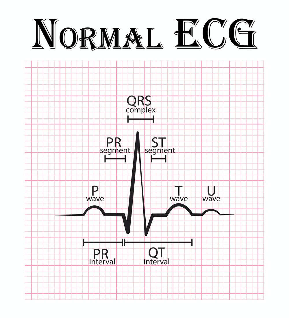 P,Q,R,S,T waves in the EKG