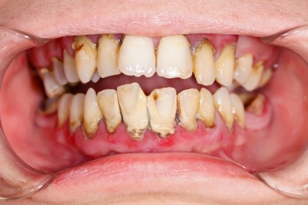 What causes cavities?