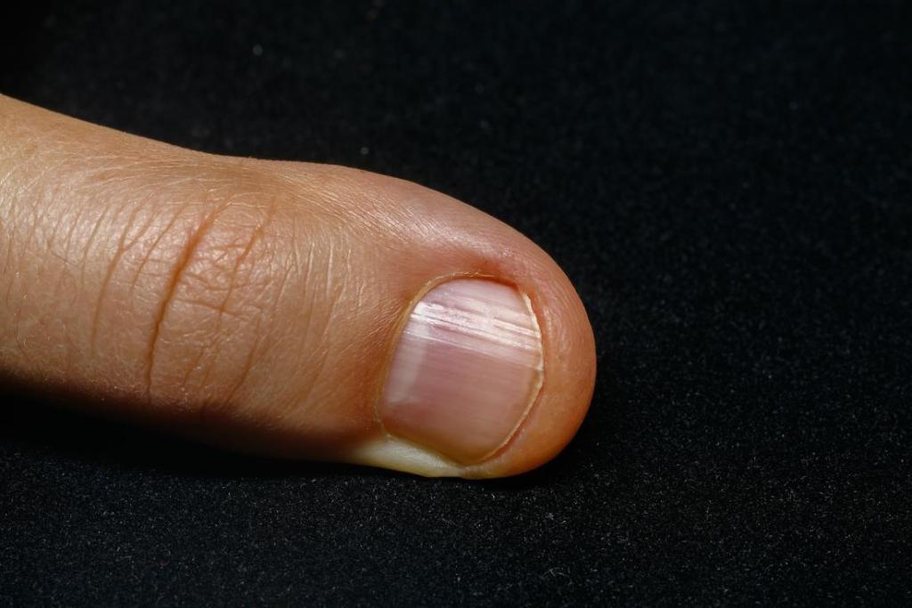 What to know about not having a half-moon on the&nbsp;nails