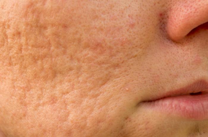 Everything you need to know about cystic acne