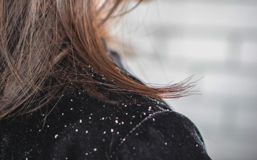Is there a link between dandruff and hair loss?