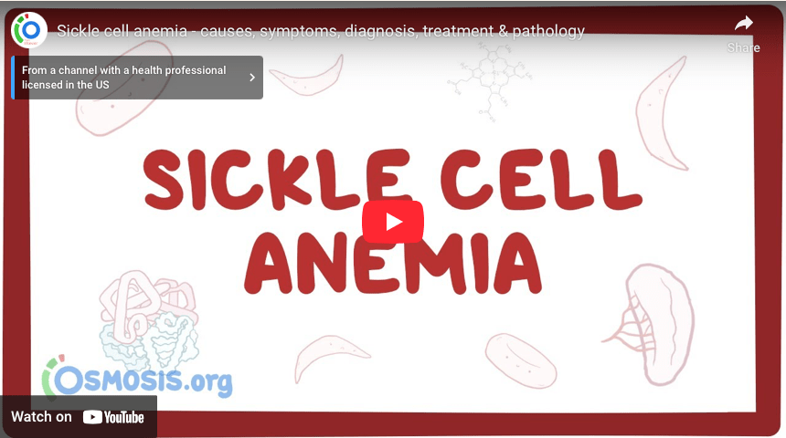 Sickle cell anemia – causes, symptoms, diagnosis, treatment & pathology